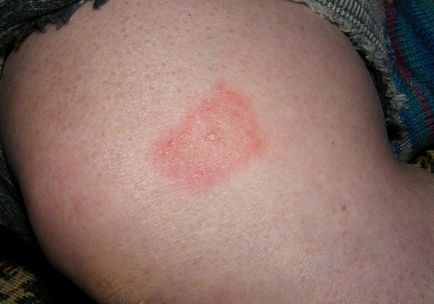 Lyme-kór vagy Lyme borreliosis, mi ez, a tünetek után kullancscsípés