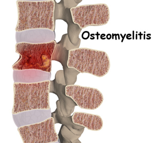 Cimentarea coloanei vertebrale