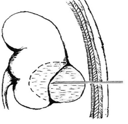 Puncție percutană a chisturilor simple la rinichi sub control ultrasonic