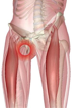 Ce trebuie să faceți cu întinderea ligamentelor simptomelor coapsei și șoldului și tratamentul bolii