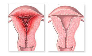 Mi az endometrium hyperplasia, mint a veszélyes következményei