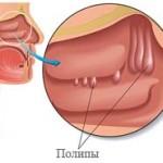 Mi az endometrium hyperplasia, mint a veszélyes következményei