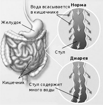 Диария след хранене от основните причини за диария след ядене