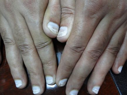 Distrofia plăcii unghiilor de pe mâinile cauzei, tratament, fotografie