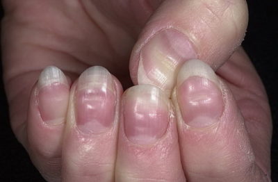 Distrofia plăcii unghiilor de pe mâinile cauzei, tratament, fotografie