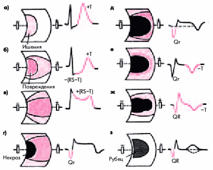 ECG diagnosticare