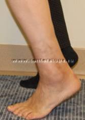 Belső protézis boka