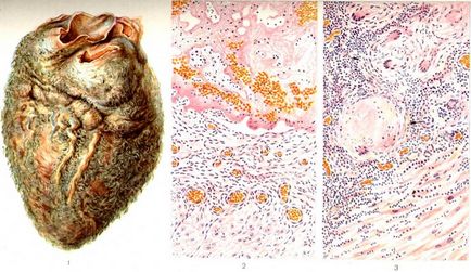 Fibrines (száraz) pericarditis tünetek, okok, kezelés, leírás