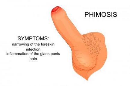 Phimosis - care medicul vindecă