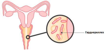 Гарднерелла у жінок лікування, симптоми, ознаки