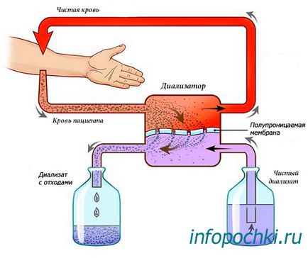 Hemodializa - care sunt indicațiile, complicațiile, dieta