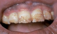 Hipoplazia cauzelor de smalț și simptomele hipoplaziei dentare