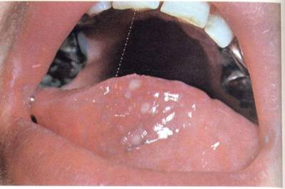 Bolile infecțioase ale mucoasei orale
