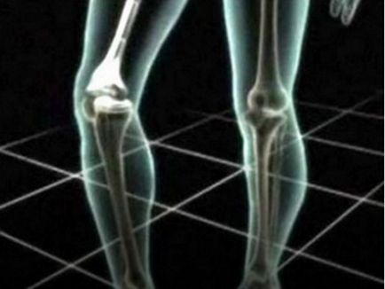 Іркутська вчені створили імплант, зрощувати після переломів кістки за місяць - новорусмір
