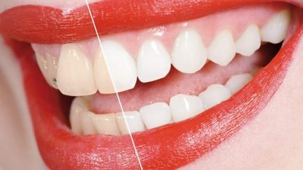Hogyan fehéríti a fogakat otthon 3 perc 100% -os eredmény! hasznos tippeket