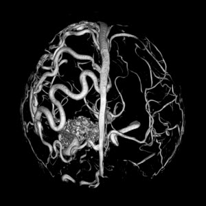 Cum să preveniți un accident vascular cerebral al creierului