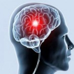 Cum să preveniți un accident vascular cerebral al creierului