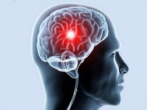 Cum să preveniți un accident vascular cerebral al creierului