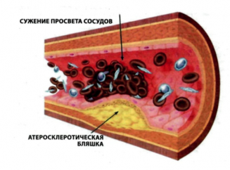 Cum arată tromboza arterială renală simptome ale bolii?