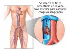 Cum arată tromboza arterială renală simptome ale bolii?