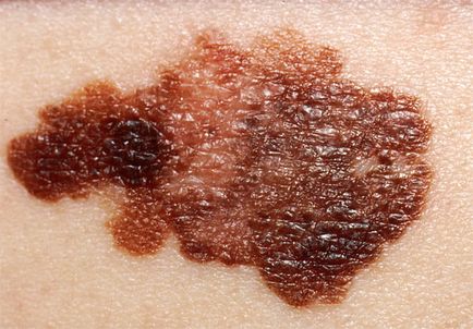 Cum sunt asociate pruritul și cancerul de piele - boli ale pielii - lista bolilor