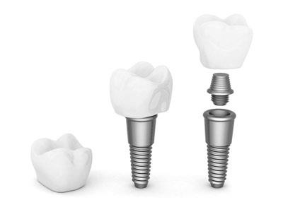 Cum sa alegi un implant dentar si sa nu pierzi pretul si calitatea