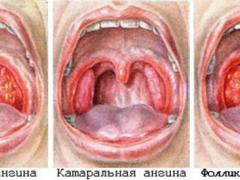 Cum arata angina pectorala?