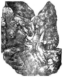 Imaginea clinică a corionepiteliomului