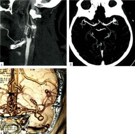 Tomografia computerizată în neurologie