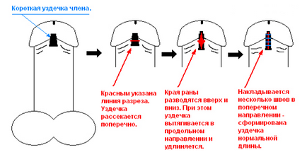 Коротка вуздечка крайньої плоті