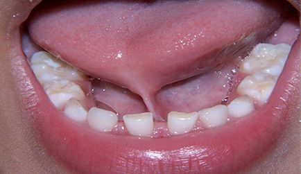 Tongue-tie okok és kezelések ankyloglossia