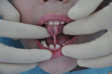 Tongue-tie okok és kezelések ankyloglossia