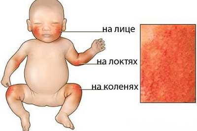 Креми, гелі та мазі від алергії для дітей особливості використання зовнішніх засобів лікування фото