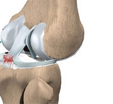 Răsucirea ligamentului articulației genunchiului, ruptura, ruperea, întinderea și modificările degenerative