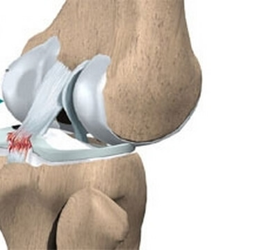 Хрестоподібна зв'язка колінного суглоба розрив, розрив, розтягування і дегенеративні зміни