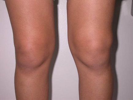 Хрестоподібна зв'язка колінного суглоба розрив, розрив, розтягування і дегенеративні зміни