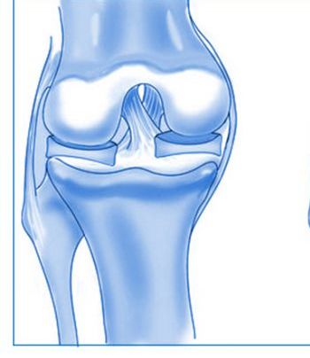 Ínszalag a térd könny, könnycsepp, húzó és degeneratív elváltozások