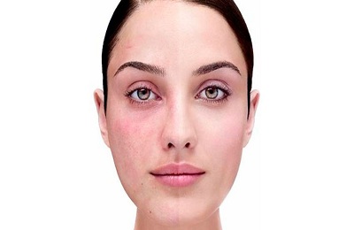 Купероз на обличчі (судинні зірочки) причини і лікування, засоби для видалення і ознаки