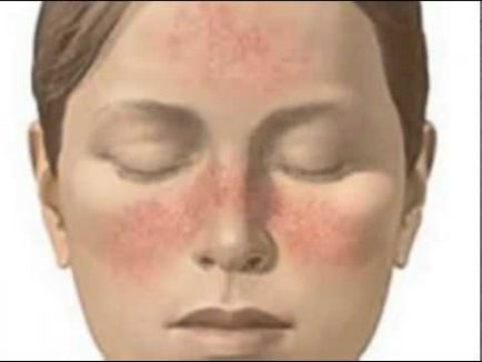 Cuperoză pe față (asteriscuri vasculare), cauze și tratament, remedii și semne