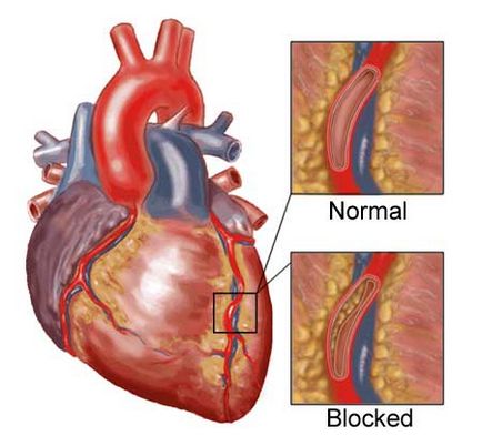 Куріння і ішемічна хвороба серця (ІХС)