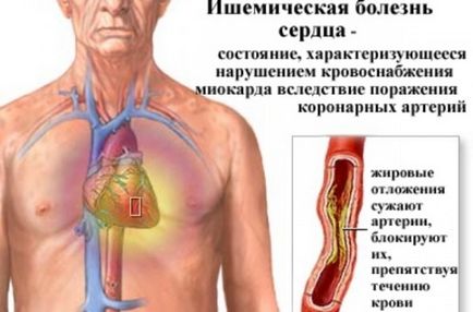 Fumatul și boala ischemică a inimii (ibs)