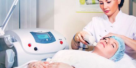 Caracteristicile laser ale peelingului facial al procedurii și recomandările de utilizare