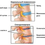 Лікування артрозу колінного суглоба в домашніх умовах симптоми, як лікувати, 2 ступеня