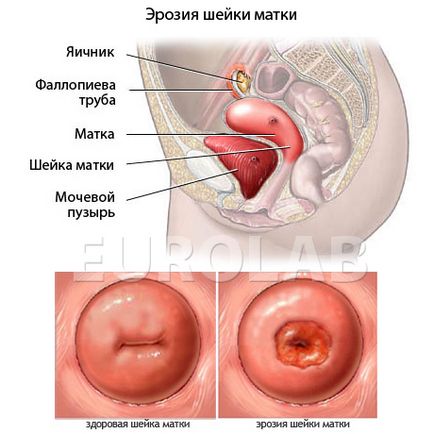 Tratamentul eroziunii cervicale - portal medical eurolab