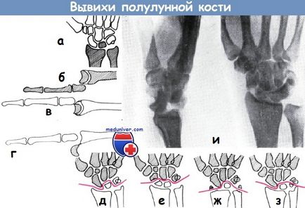 Tratamentul fracturilor și dislocărilor osului semilunar