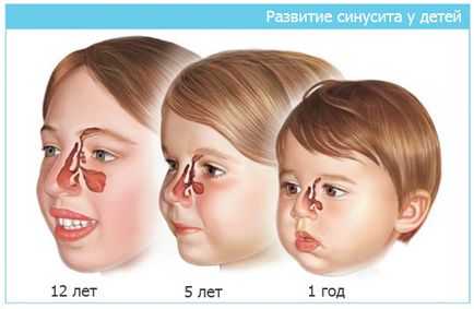Tratamentul sinuzitei la copiii din Moscova, pentru a vindeca sinuzita la un copil în cabinetele de medicină clinică