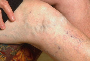Лікування варикозу вен на ногах