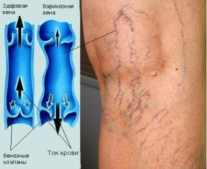 Лікування варикозу вен на ногах