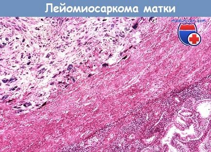 méh leiomioszarkóma - klinikai kép, diagnózis (leiomyosarcoma) méh leiomioszarkómában - klinikai kép, diagnózis