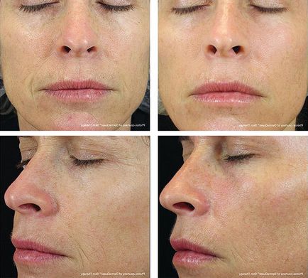 Lpg масаж обличчя (космеханіка або ендермоліфт) що ж це за процедура